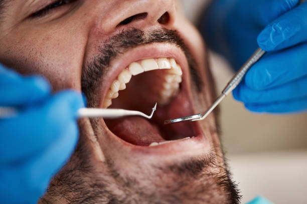 Best Emergency Wisdom Teeth Removal in West Swanzey, NH